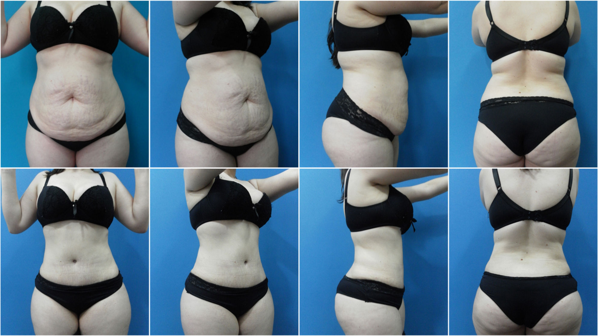 Abdominoplastia (1)