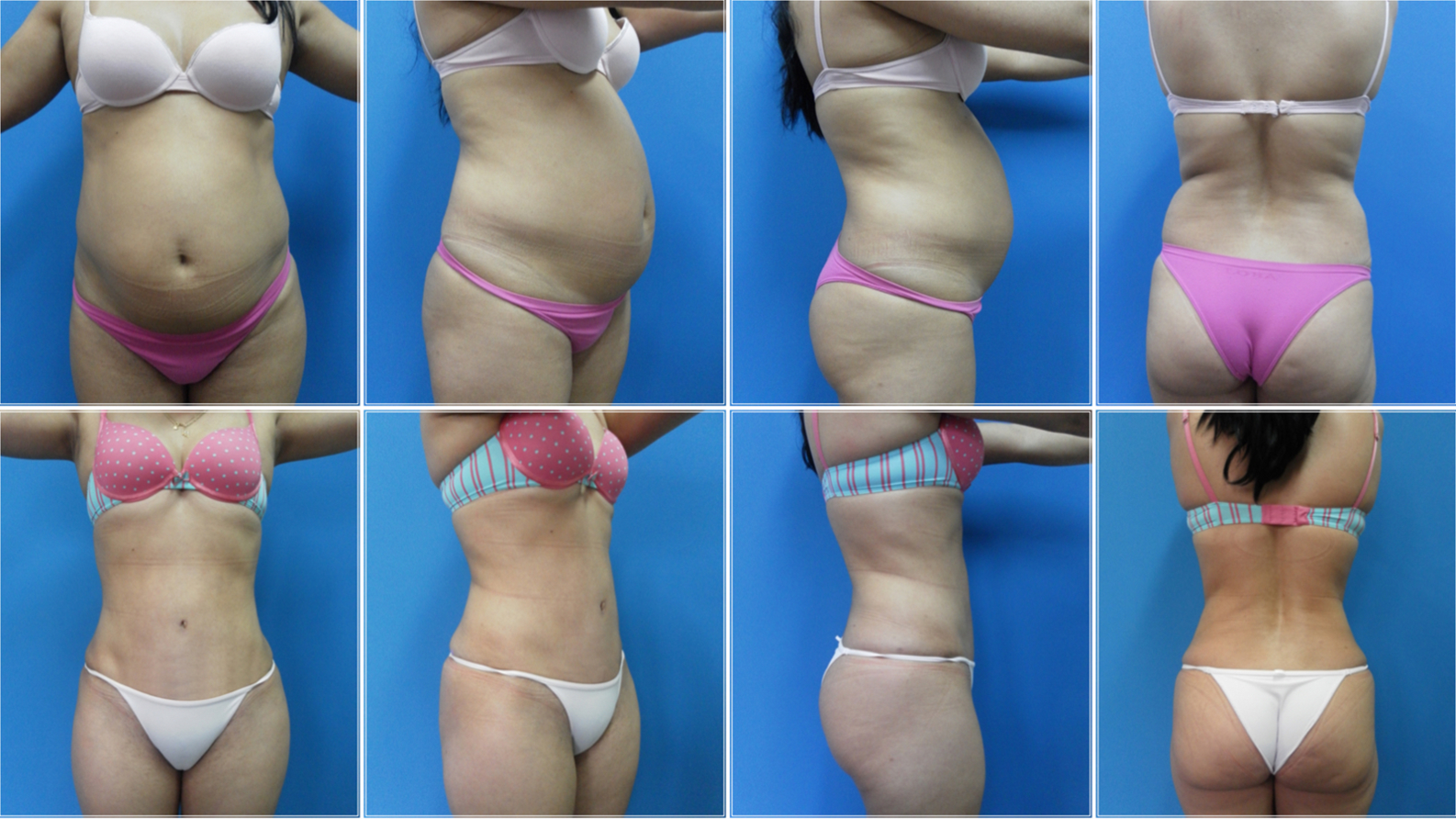 Abdominoplastia (3)