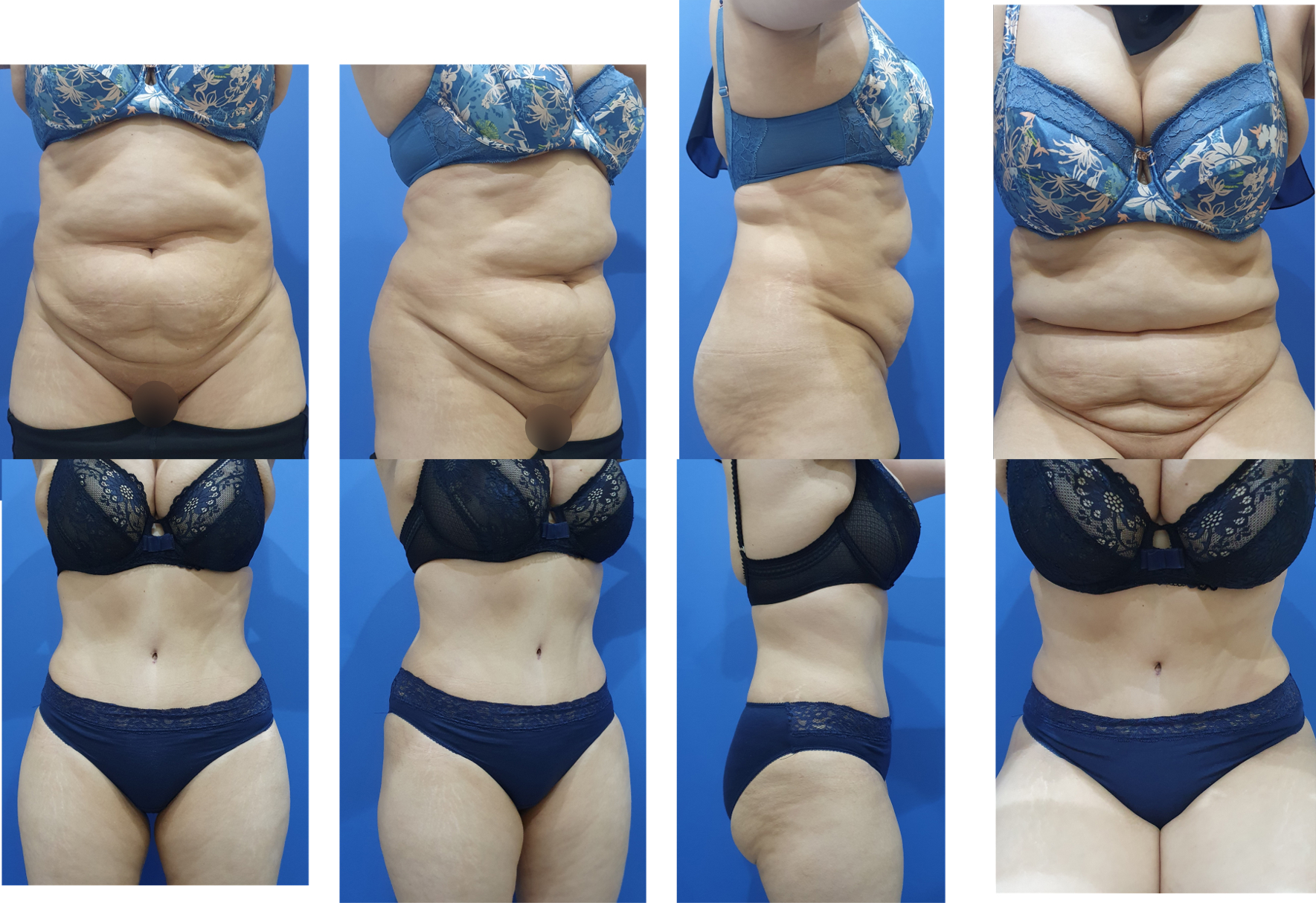 Abdominoplastia (4)