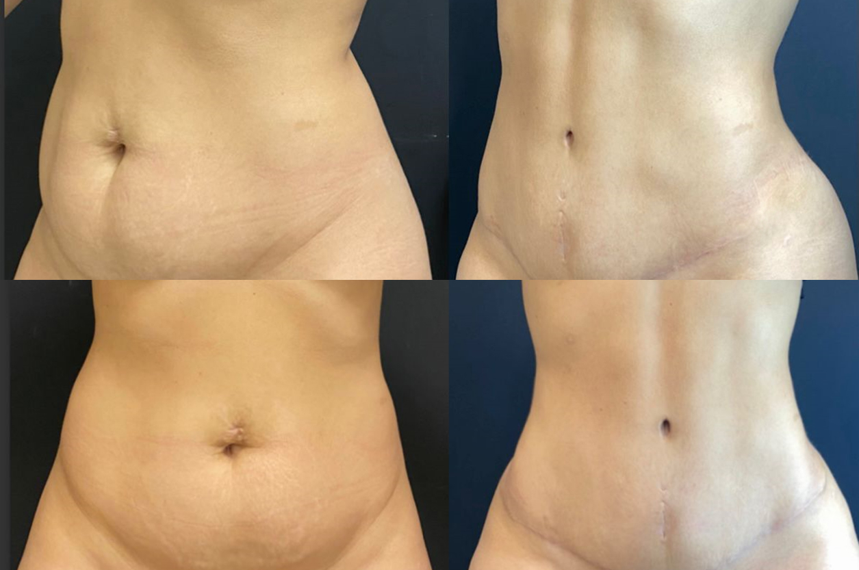 Abdominoplastia (5)