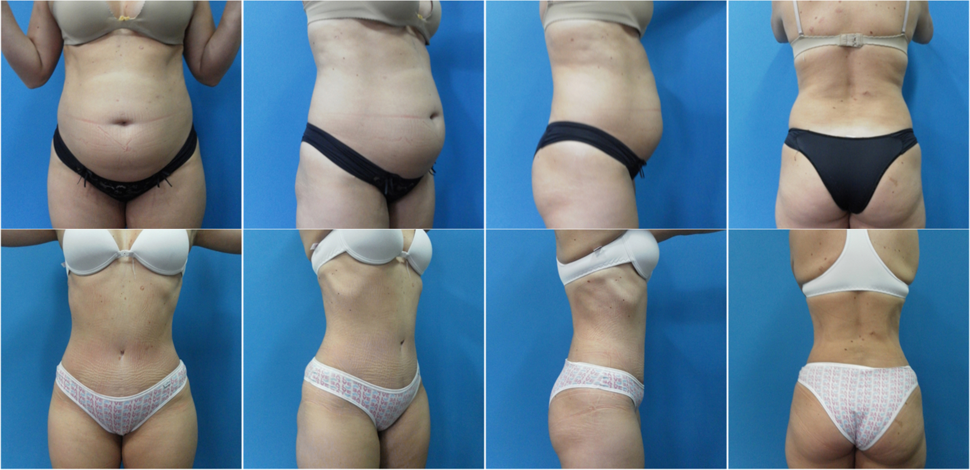 Abdominoplastia (6)