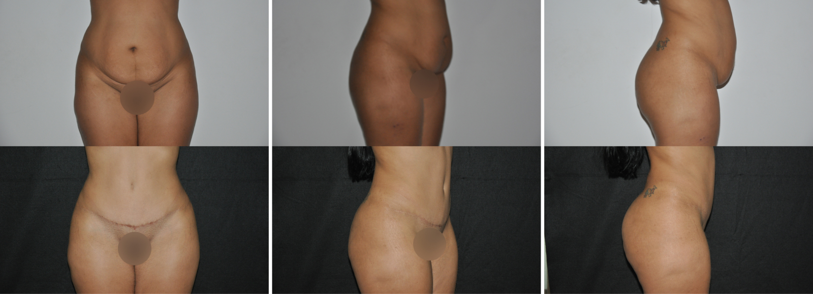 Abdominoplastia (7)