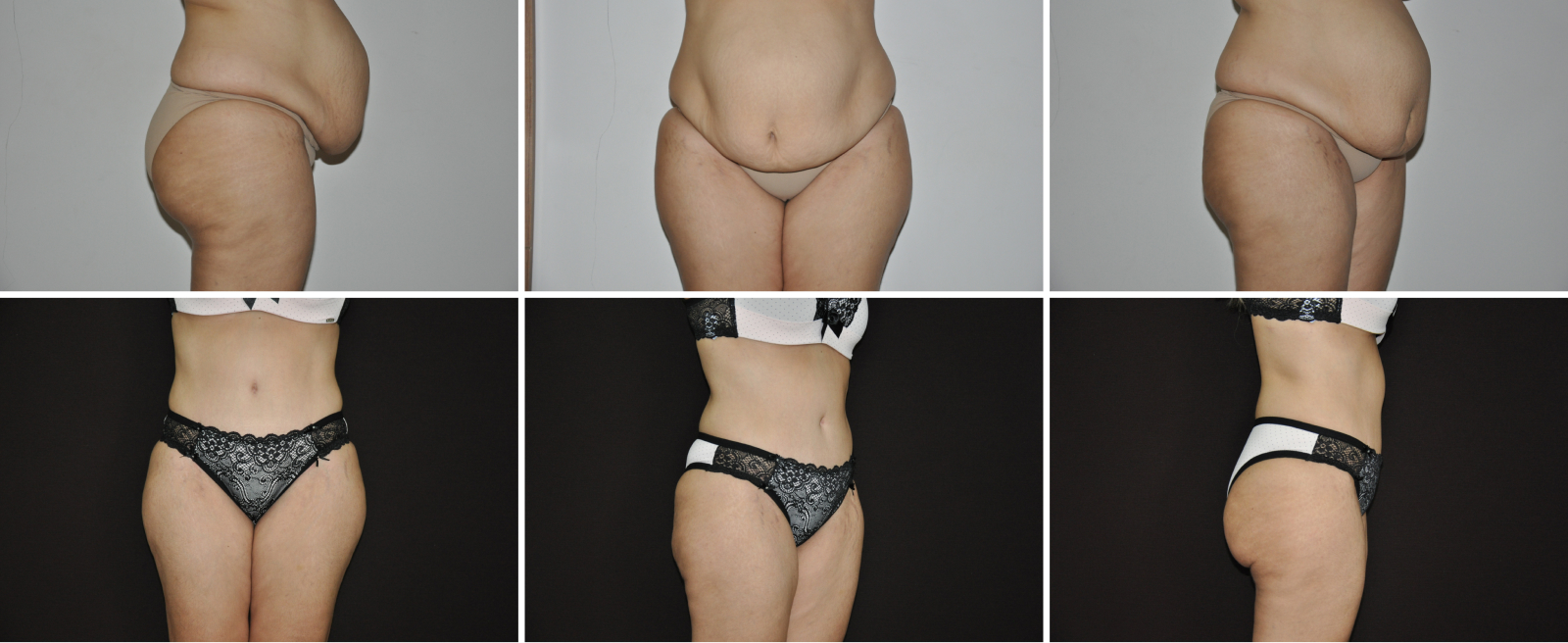 Abdominoplastia (8)