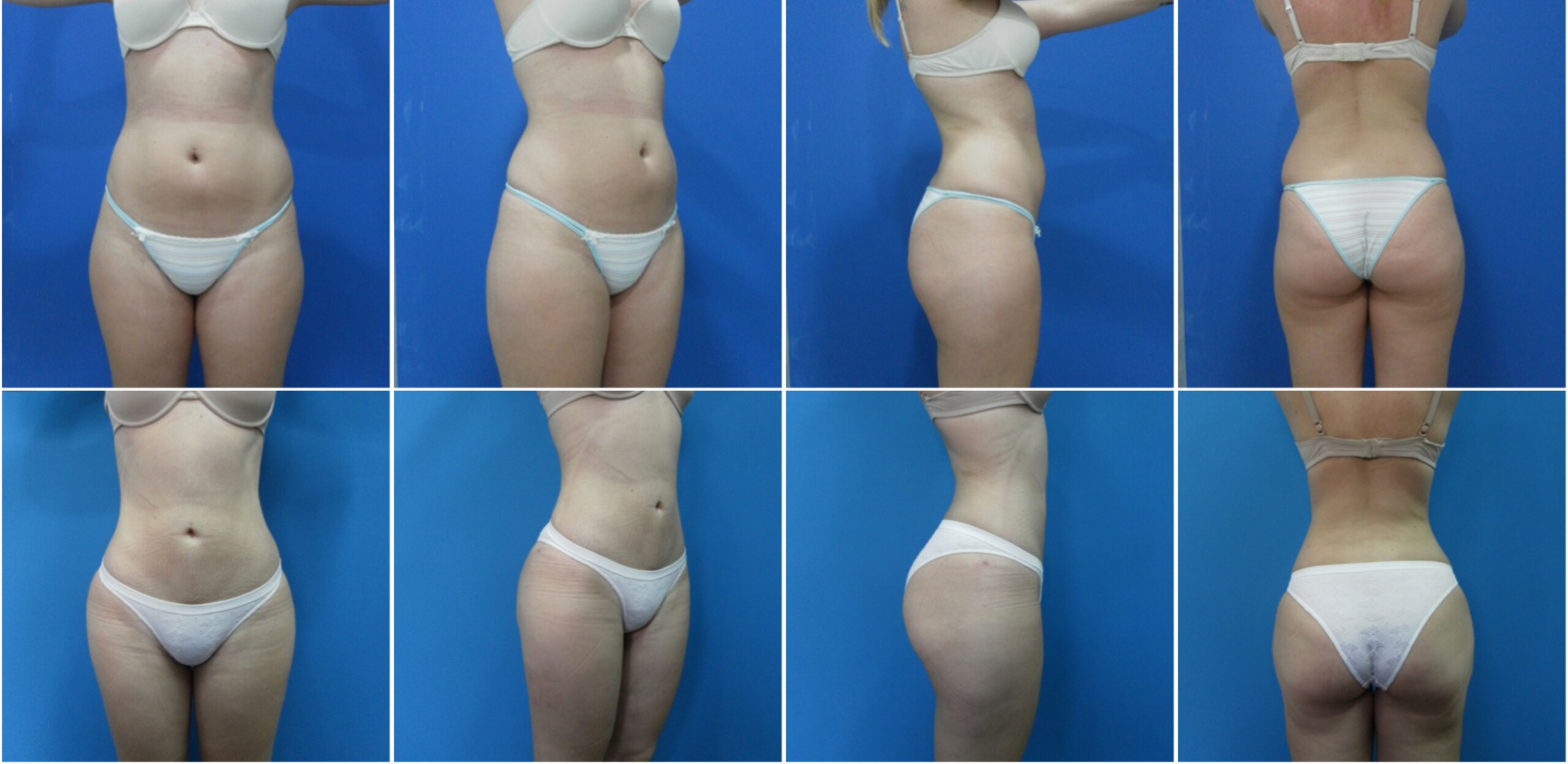 lipo (1)
