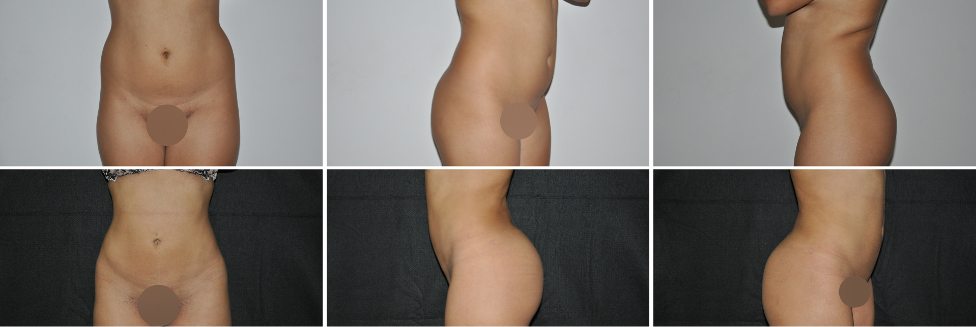 lipo (3)