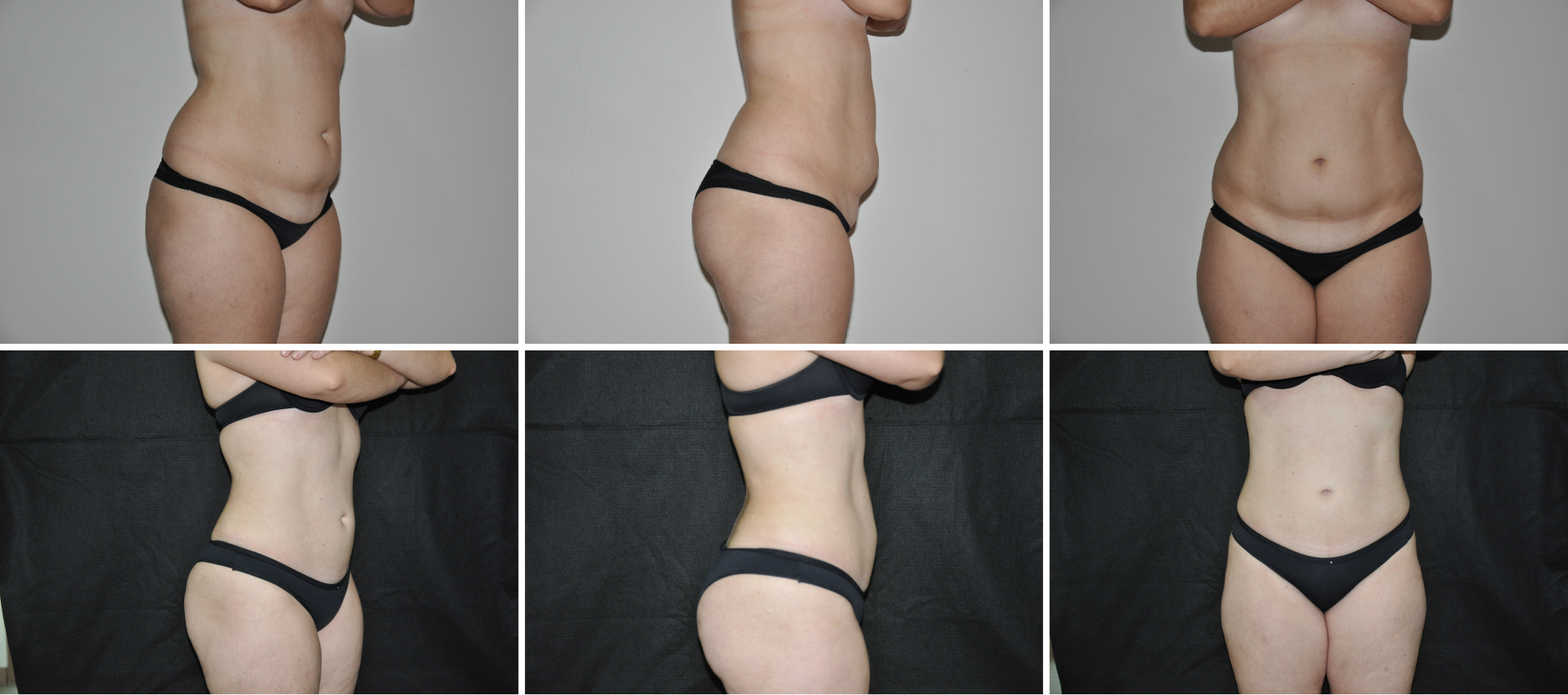 lipo (4)