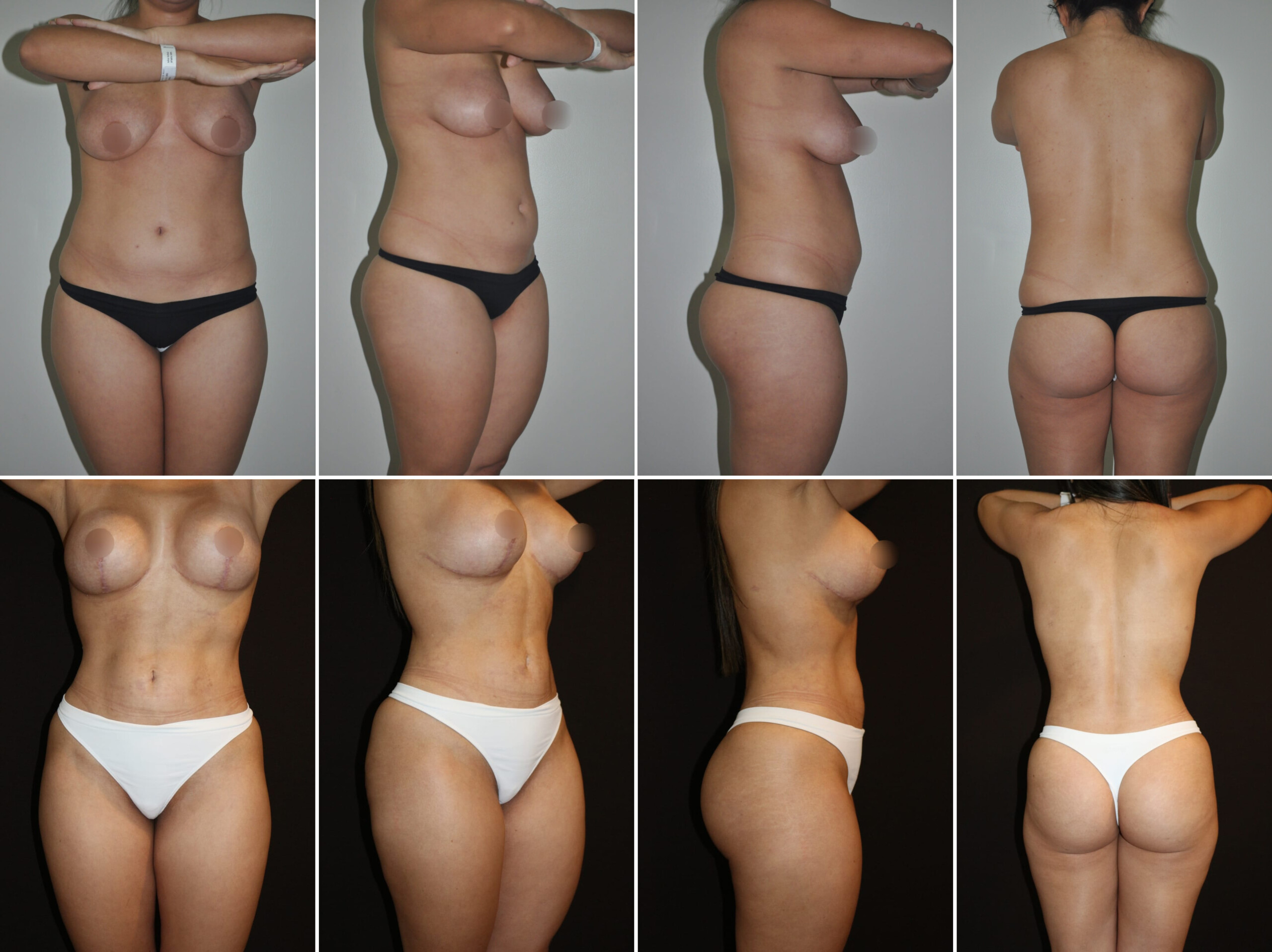 lipo (5)