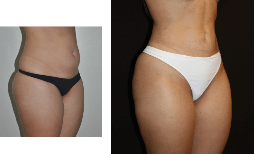 lipo